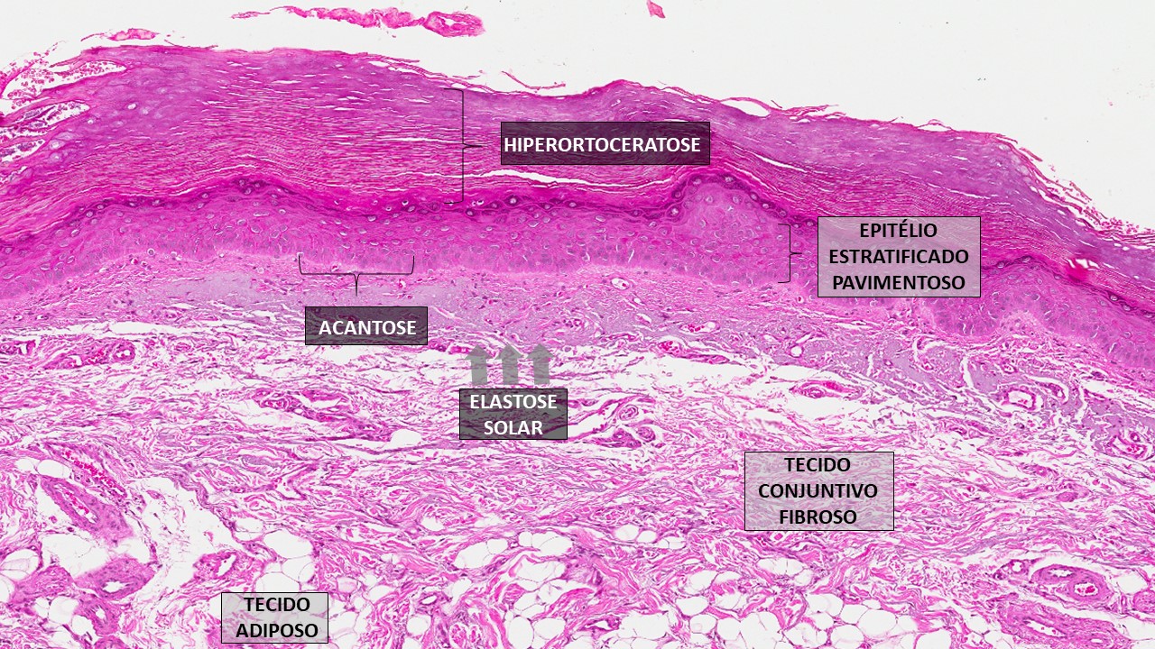 cancer bucal histologia